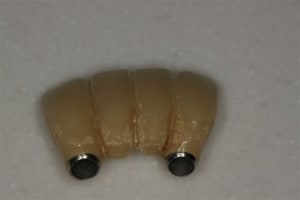 Implants 32 42  4  pktbxq - Eugenol