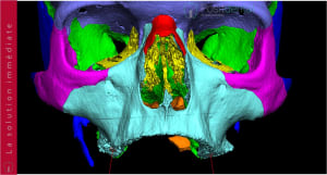 Implants ptérygoïdien 001 qzklwy - Eugenol