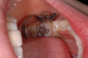 Initial tilxm4 - Eugenol