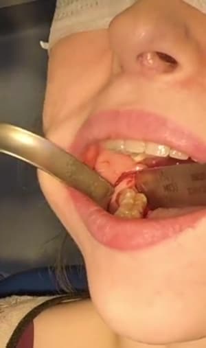 Lambeau lingual mpsimx - Eugenol