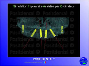 Mci  mise en charge imm diate  chirurgie implantaire guid e 004 vrmge0 - Eugenol