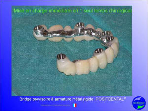 Mci  mise en charge imm diate  chirurgie implantaire guid e 011 ajcano - Eugenol