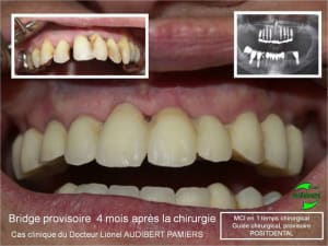 Mci en 1 temps chirurgical 1 ogel86 - Eugenol