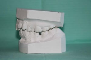 Moulage 2 dllhb9 - Eugenol