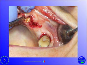 Mise en chage imm diate 006 zpwhde - Eugenol