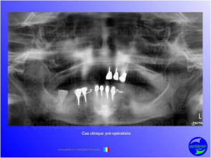 Mise en chage imm diate 060 lhalg1 - Eugenol