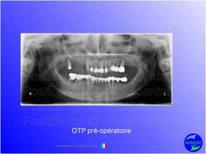Mise en chage imm diate 107 qzxtnf - Eugenol