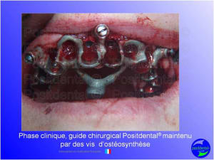 Mise en chage imm diate 111 ijr8rr - Eugenol