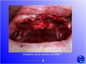 Mise en chage imm diate 112 c2vaki - Eugenol