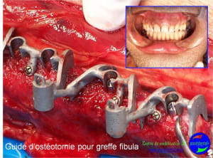 Mise en chage imm diate 119 azgalv - Eugenol