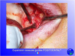 Mise en chage imm diate 133 ncopfy - Eugenol