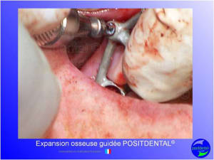 Mise en chage imm diate 153 nyzqop - Eugenol