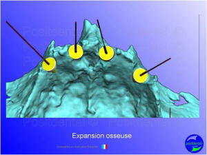 Mise en chage imm diate 159 lvvvsh - Eugenol