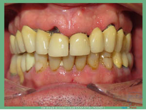 Mise en charge immédiade c - Eugenol