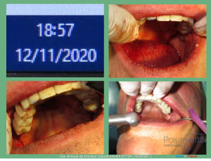 Mise en charge immédiade c - Eugenol