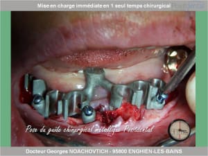 Mise en charge immédiate en chirurgie guidée positdental 004 uxznt1 - Eugenol