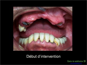 Mise en charge immédiate implant dentaire 017 vqajrz - Eugenol