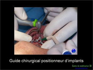 Mise en charge immédiate implant dentaire 028 egsy0f - Eugenol