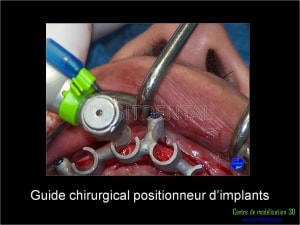 Mise en charge immédiate implant dentaire 032 tf3duo - Eugenol