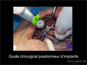 Mise en charge immédiate implant dentaire 033 dprag1 - Eugenol