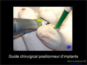 Mise en charge immédiate implant dentaire 036 q2bgep - Eugenol