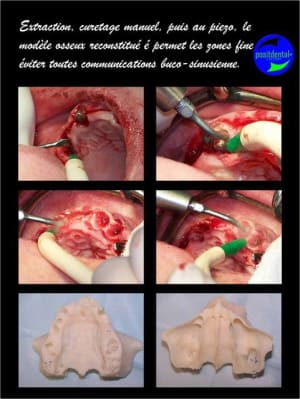 Mise en charge imm diate bridge provisoire sur implants 2 wgznby - Eugenol