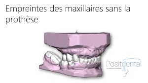 Mise en charge innédiate positdental 002 uhvxh1 - Eugenol