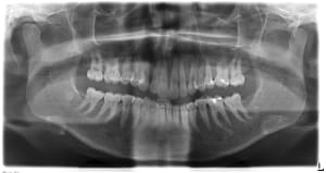 Pano angiome g3zovu - Eugenol