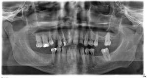Pano kyste o6xmuc - Eugenol