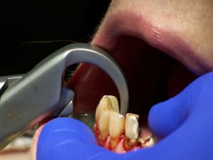 Positdental 141120 103 gb5lvy - Eugenol