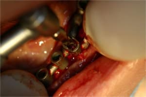 Positdental 2 ohqwnb - Eugenol
