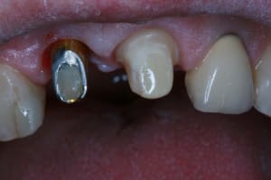 Pr  op couronnes 11 21 006 rwkvgc - Eugenol