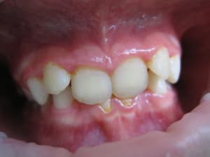 Photos endobuccales  1  ap7xrd - Eugenol