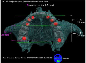 Planification implantaire assist e par ordinateur positdental extension  giagvn - Eugenol