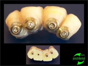 Porte implant triple focntion euroteknika 2 pk6rhh - Eugenol