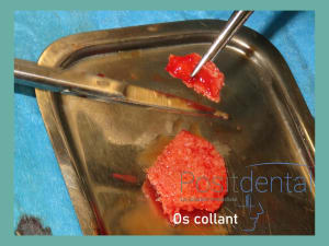 Positdental mise en charge immédiate 008 vfqvfc - Eugenol