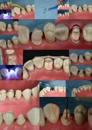 Premolaire wi4lv9 - Eugenol
