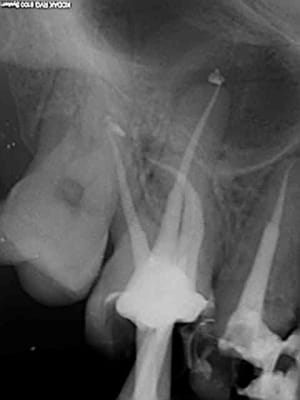 R5 tb4mva - Eugenol