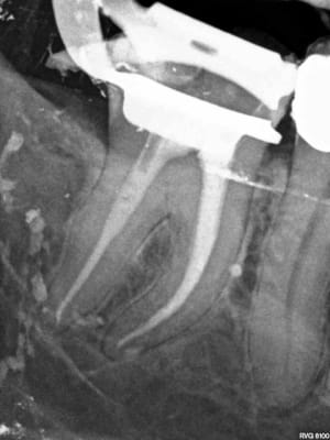 R post op n2bluv - Eugenol