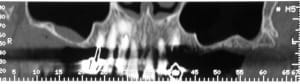 Radiographie n 1 layxx1 - Eugenol