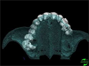 Simullation implantaire assist e par ordinateur positdental 004 rjgla6 - Eugenol