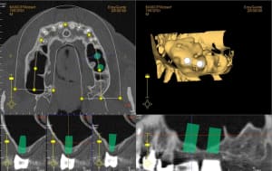 Sinus lift fkw1mf - Eugenol