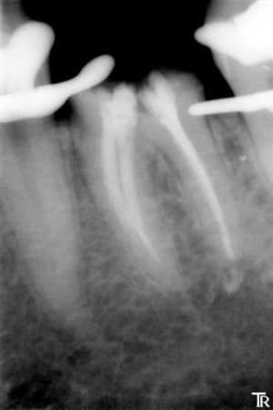 Tr microseal   digue yffwpz - Eugenol