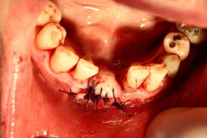 implant e xvjhxv - Eugenol
