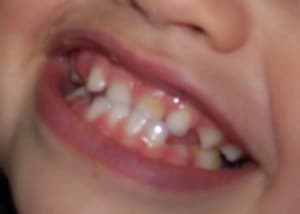 Bouche jhiex0 - Eugenol