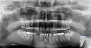Canine incluse3 crququ - Eugenol