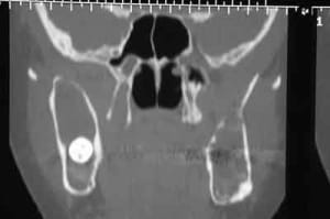 Cas clinique scanner 1 lxblmw - Eugenol