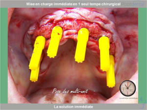 Chirurgie guidée mise en charge immédiate 0021 kxdmhr - Eugenol