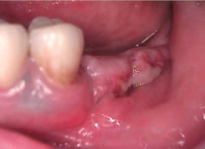 Cicatrisation 10 jours yh2hgp - Eugenol