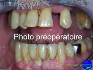 Cicatrisation gingivale suite eimci positdental 1 ugavya - Eugenol
